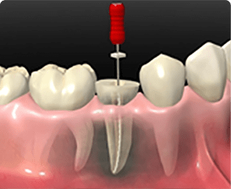 根管治療・歯内療法