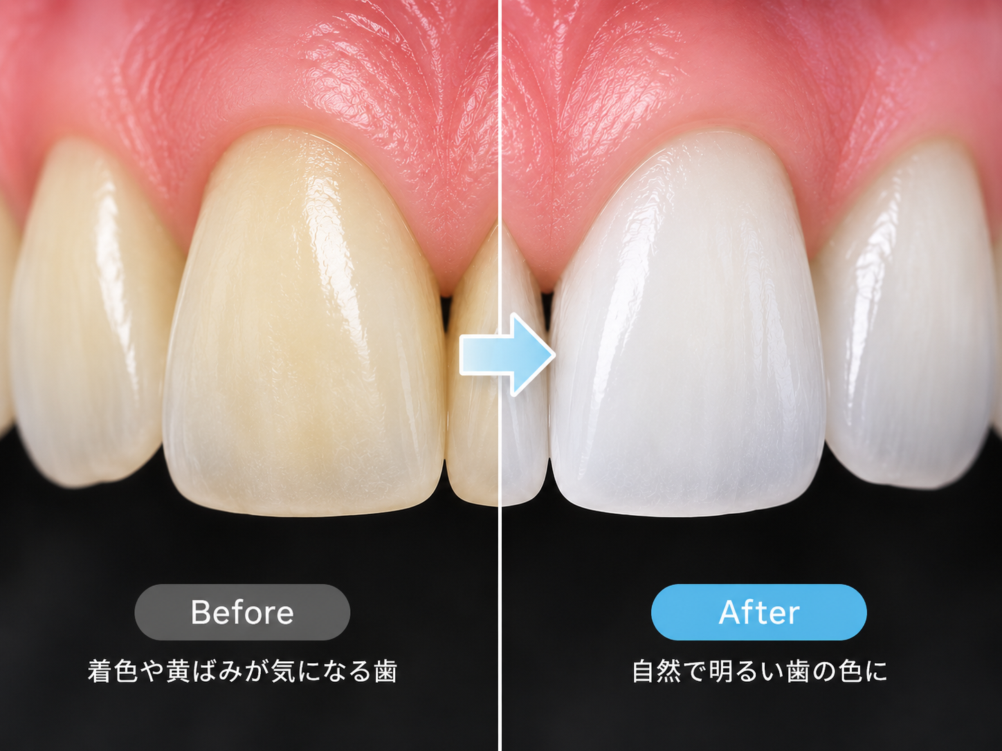 ホワイトニングの説明イメージ
